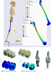 Musculoskeletal model coupled with ANSYS allows simulation of femur stresses during gait. Residual stresses in a partial denture. Knee joint.